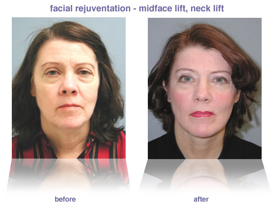 new york plastic surgery